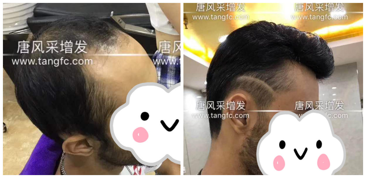 男士假發(fā)容易看出來嗎？看看做過頭發(fā)的發(fā)友怎么說！